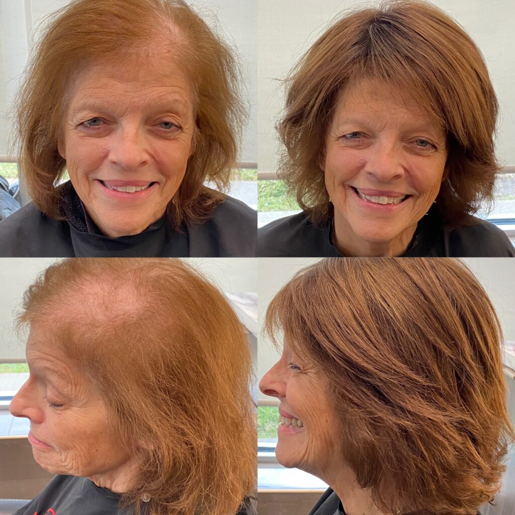 Hair restoration result