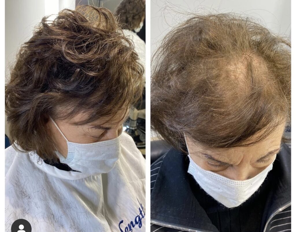 Hair restoration result