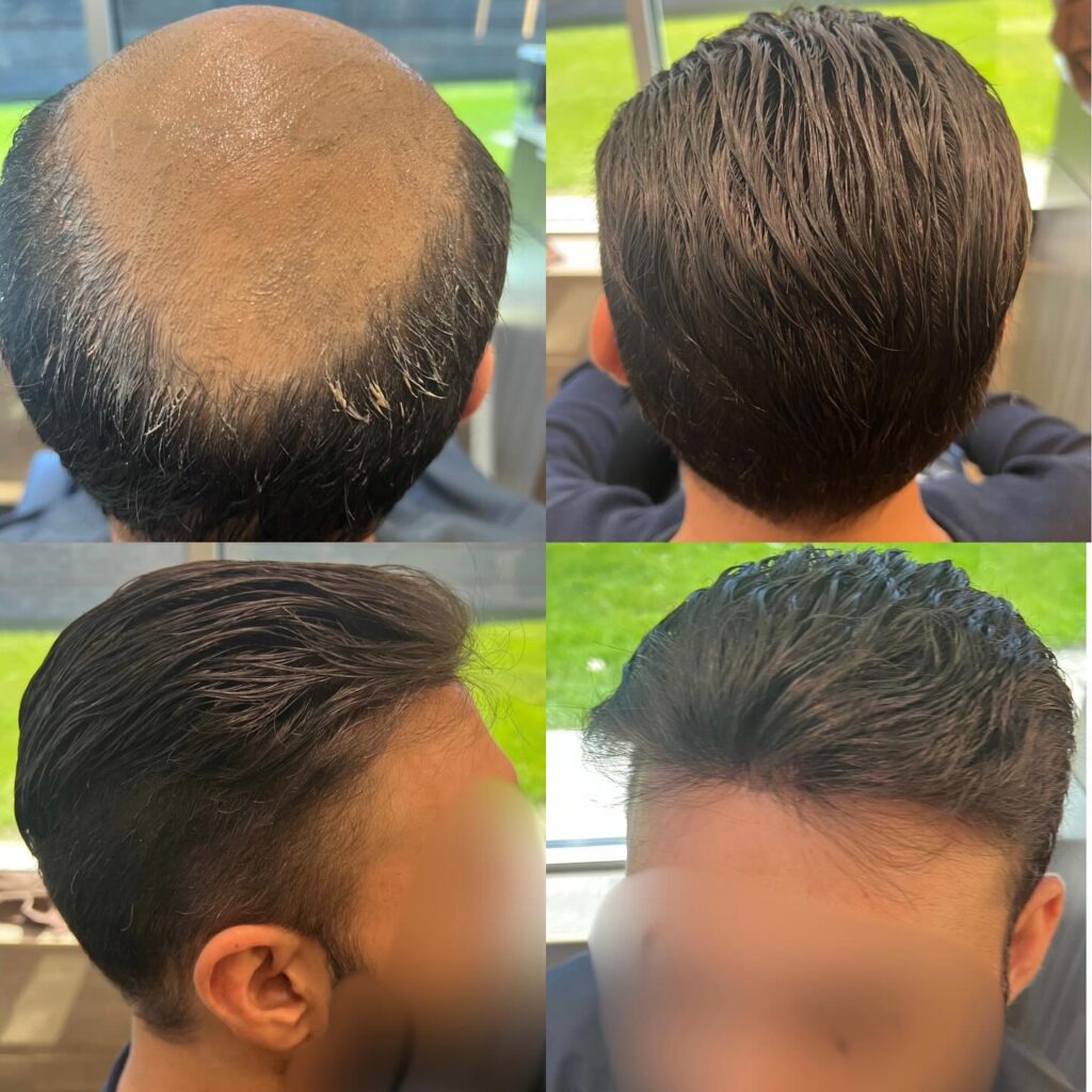 Hair restoration result
