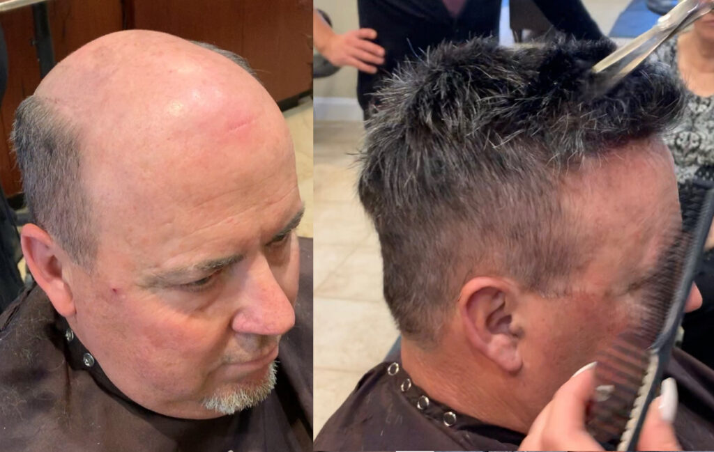Hair restoration result