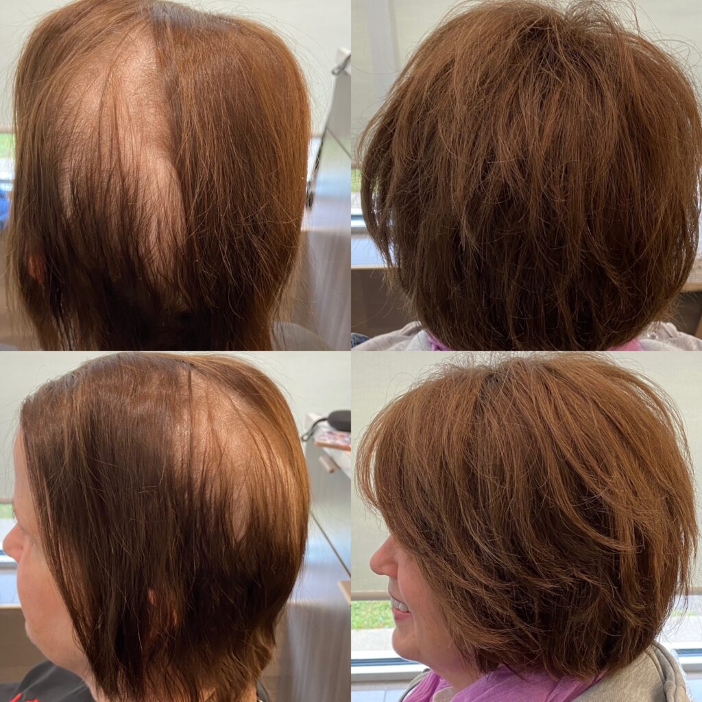 Hair restoration result