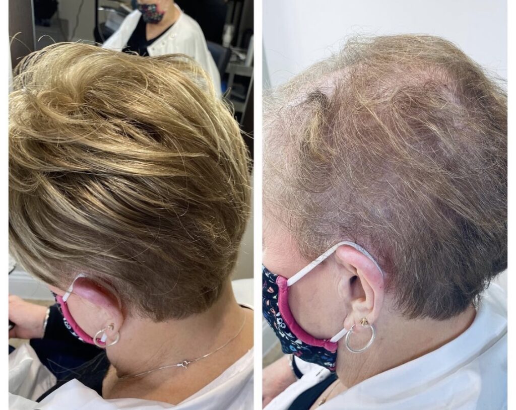 Hair restoration result