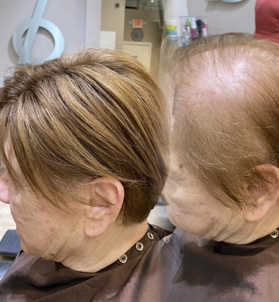 Hair restoration result